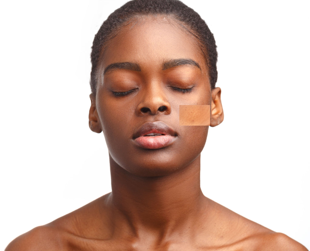 Article: Acne: Considerations for darker skin